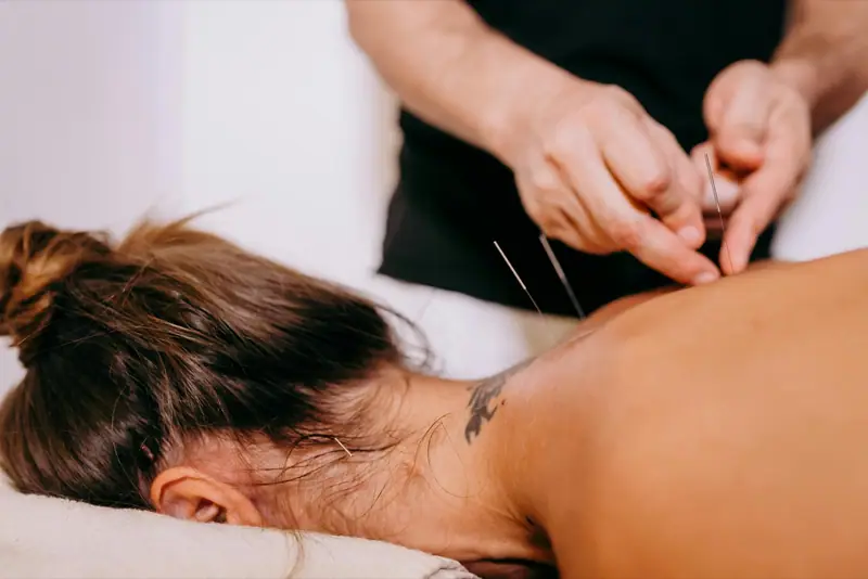 Acupuncture needles being placed along a client's back